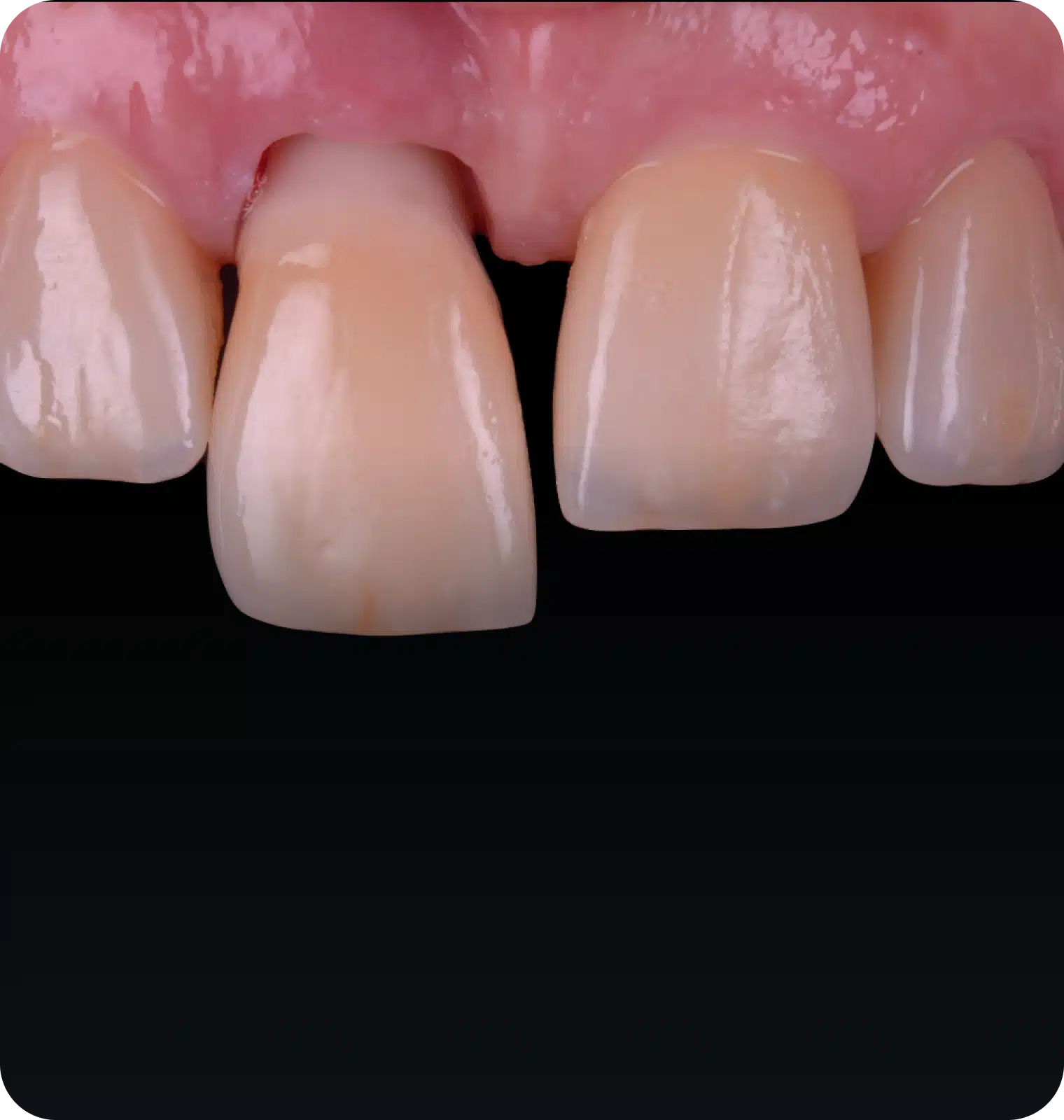 Module 3 : Masterclass Implants